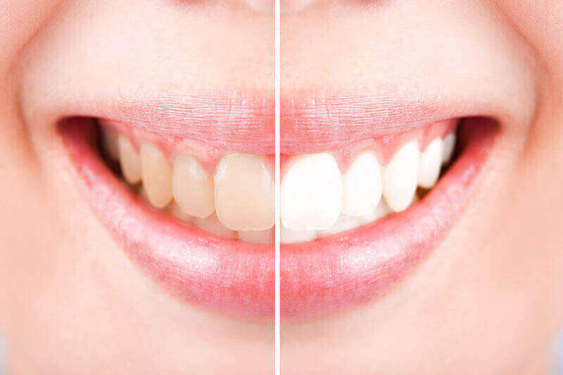 Teeth Whitening Mississauga