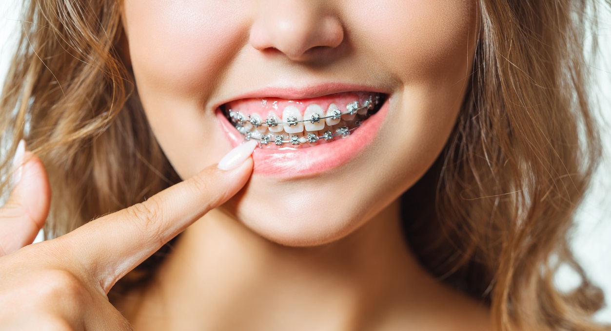 LOW COST Braces From $3,900 in Mississauga