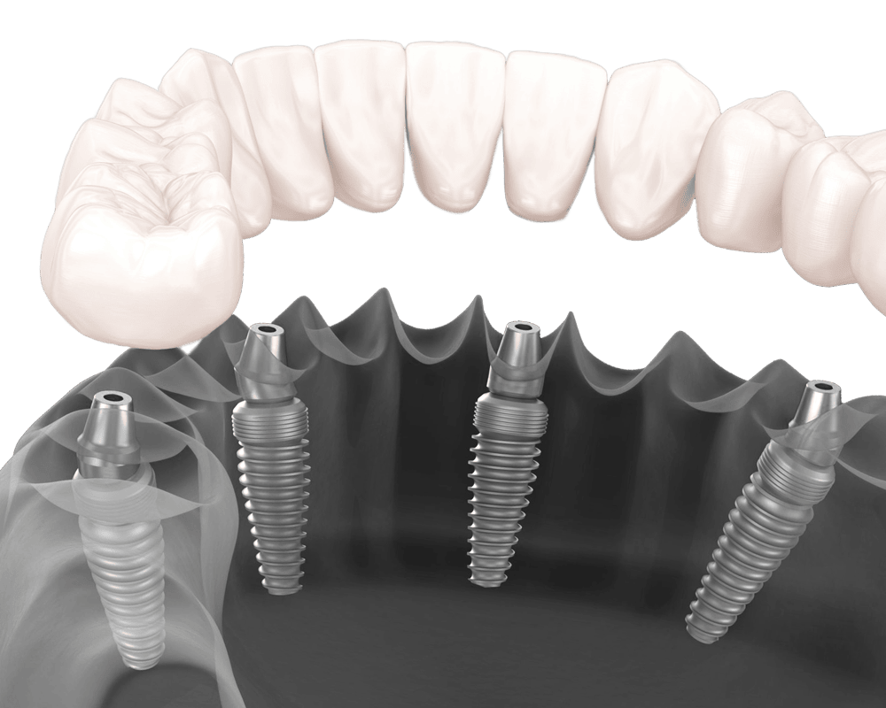 An image illustrating All-on-X dental implants, showing titanium implants inserted into the jawbone to support a fixed full arch prosthesis resembling natural teeth.