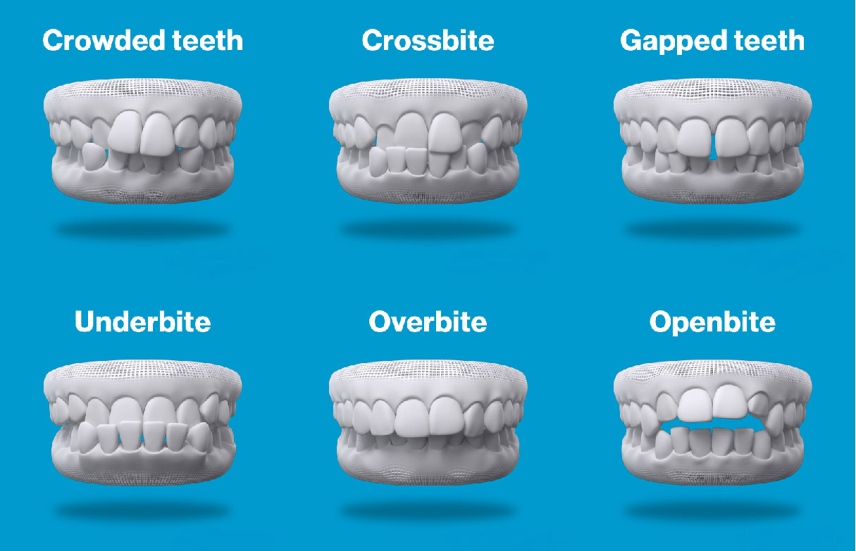 Canadian Made Clear Teeth Aligners ✔️ Invisible Oral Treatment