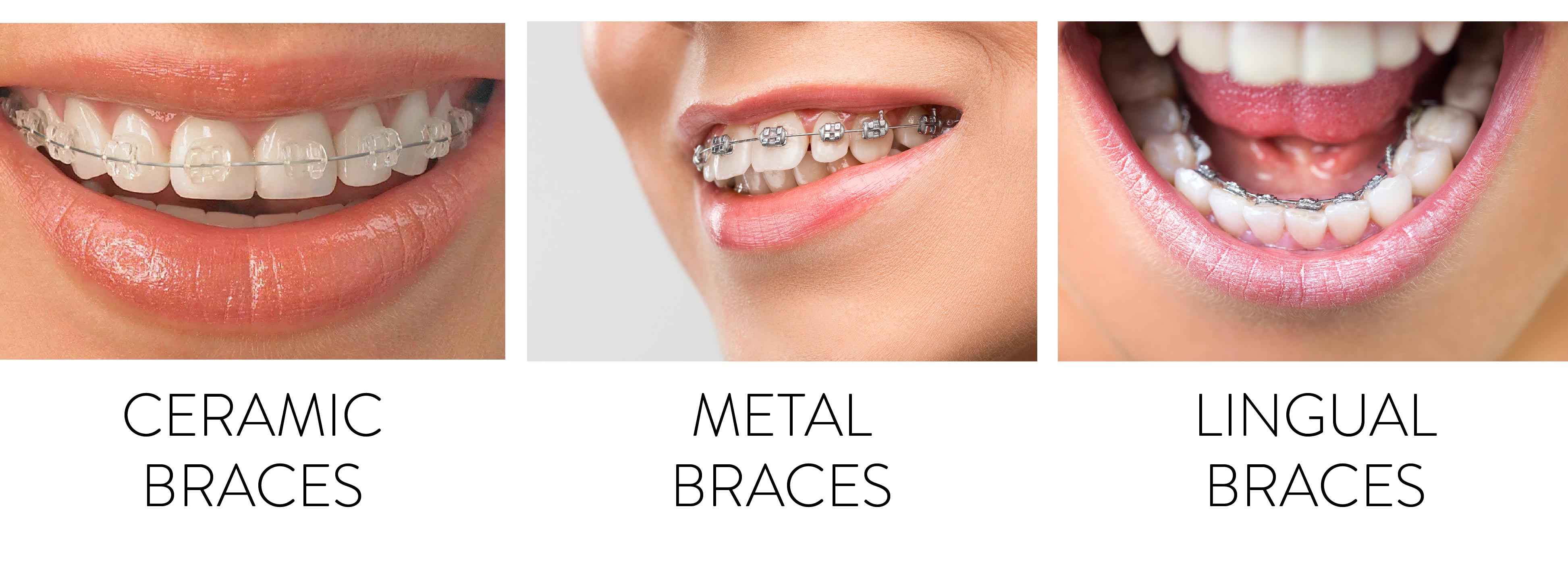 Types of Braces